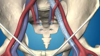 Medtronic's Abre™ Venous Self-Expanding Stent System product animation