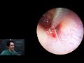 home earwax removal eardrum perforation