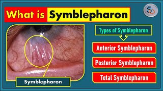 What is Symblepharon \u0026 Its Types?