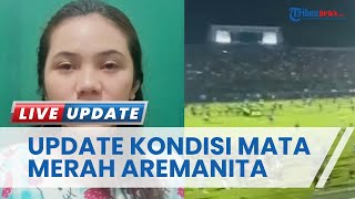 Update Kondisi Mata Merah Aremanita Korban Tragedi Kanjuruhan, Berangsur Membaik Setelah Lakukan Ini