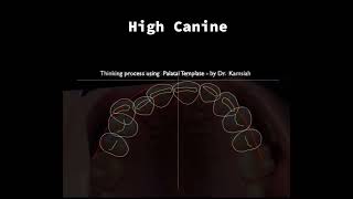 High Canine , palatal planning