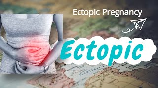 Laparoscopic Management of Ectopic Pregnancy