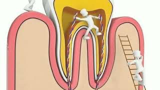 Root canal treatment મૂળિયાં ની સારવાર (RCT)