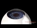 hydrus microstent for glaucoma