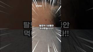 탈모약 1년 먹은 미친 찐후기