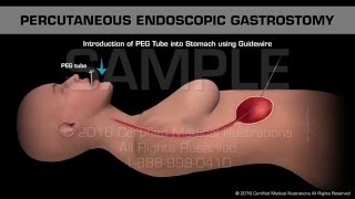 Percutaneous Endoscopic Gastrostomy