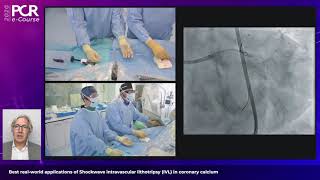 Best real-world applications of Shockwave IVL in coronary calcium - PCR e-Course 2020