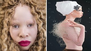 South African Albino Beauty Become A Model