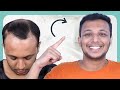 Hair Transplant: 10-Month Results 😃 | Hair Transplant in Bangladesh | New Roots