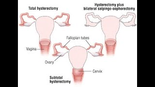 TOTAL ABDOMINAL HYSTRECTOMY WITH BILATERAL SALPHINGO-OPRECTOMY- TAH e BSO