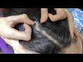 Lices Nits Picking Scalp close of Black Shiny Hair||ASMR PAKISTAN