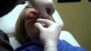 Numbing Shots Video Preparing for Liquid Facelift Procedure- Dr. Seiler