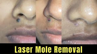 Laser mole removal| Scarless mole removal surgery| Best mole removal in Ranchi #moleremoval