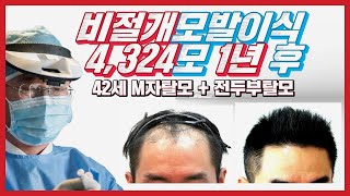 비절개모발이식 4,324모 1년 모발이식 전 후 사진 M자탈모 전두부탈모