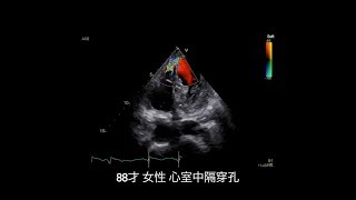 【心臓手術】心室中隔穿孔に対する外科的修復術 Post-infarction VSD with Extensive Right Ventricular Free Wall Infarction