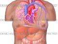 breast cancer metastasis