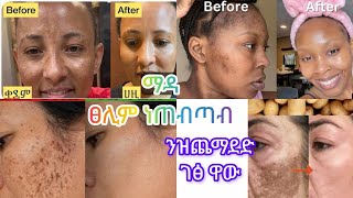 ብቡዙሓት ዝተመስከረሉ ንቡዙሓት ዘሕወየ ናይ ድንሽ ክሬም  /home made potato 🥔 cream for oll type of skin / #habesha #skin