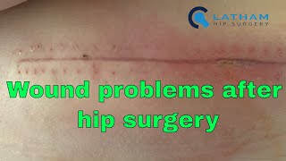 Wound problems after hip surgery