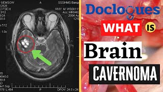 What Is Brain Cavernoma?