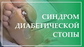 Синдром диабетической стопы. Биологическая медицина в лечении некробиотических трофических язв