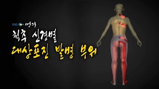 [명의 의학백과📖] 척추 신경별 대상포진 발병 부위