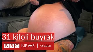 Дунёдаги энг катта буйрак олиб ташланди, у 31 кило эди - BBC News O'zbek