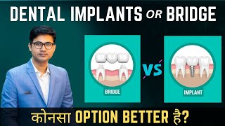 Dental Implant vs Bridge | In Hindi | Missing Teeth के लिए क्या बेहतर है?