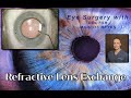 Refractive Lens Exchange   4K