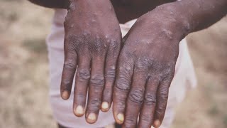 VB health director talks about concerns over worldwide monkeypox outbreak