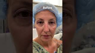 Upper Blepharoplasty (Eyelid Lift): Before and Immediately After!