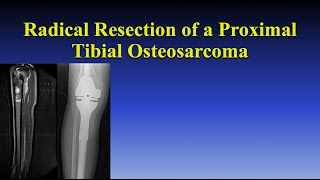 Radical Resection of a Proximal Tibial Osteosarcoma