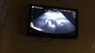 Lipman Barwell 39 week ultrasound