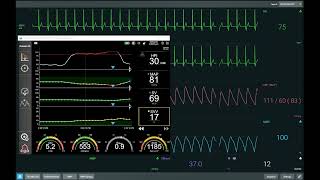 Acumen Hypotension Prediction Index Case Study 2 - Fluid bolus intervention