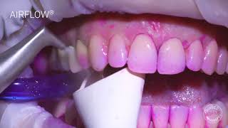 Professional tooth cleaning on a healthy patient with GBT Guided Biofilm Therapy