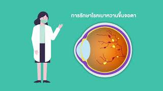 ผู้สูงวัยใส่ใจดวงตา l โรคของจอประสาทตา ตอนที่ 3 โรคเบาหวานขึ้นจอตา #ศูนย์ศรีพัฒน์ #เบาหวาน #จอตา