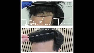 Hairline Lowering At Temples for Receding Hairline,  Hair Transplant By Dr Mark Tam, Harley Street