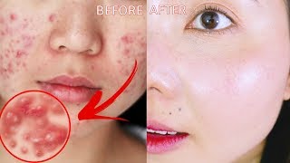 DƯỠNG DA TRỊ MỤN NGON BỔ RẺ //ACNE SKINCARE ROUTINE ft. StyleKorean