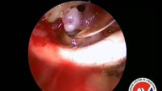 endoscopic endonasal AcomA Aneurysm clipping