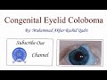 Congenital Eyelid Coloboma - Optometry Club