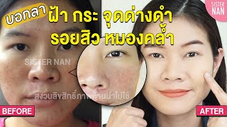 ลดรอยดำ รอยสิว จุดด่างดำ ฝ้า กระ โทรม หมองคล้ำ หน้าพัง หน้าสว่างขึ้น หน้ากระจ่างใส | แนน Sister Nan