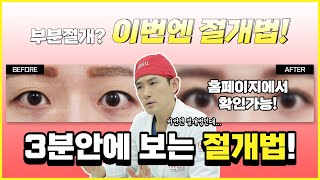 절개법 쌍꺼풀에는 다 이유가 있다? 절개법 쌍꺼풀 3분 안에 알아 보기 | iWELL Plastic Surgery 아이웰성형외과