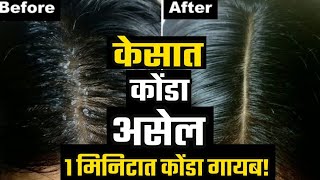 केसातील Dandruff व कोंडा मिटवा!करा हा घरघुती उपाय