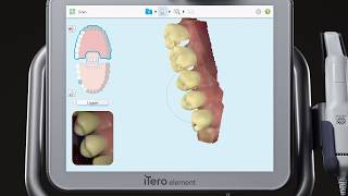 Charting and scanning for an implant | iTero™ scanner tutorial