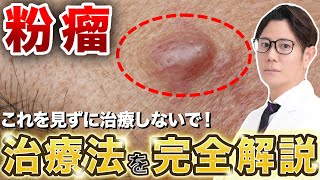 Causes and Treatment of Atheromas: Explained by a Japanese Dermatologist