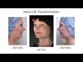 neck lift transformation by dr. e.levit. before u0026 after.