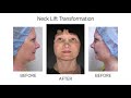 neck lift transformation by dr. e.levit. before u0026 after.