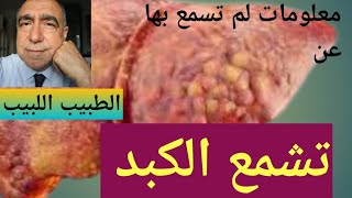 تشمع الكبد الاسرار و الخطورة