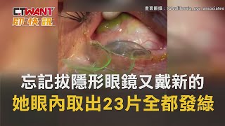 CTWANT 國際新聞 / 忘記拔隱形眼鏡又戴新的　她眼內取出23片「全都發綠」