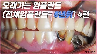 [대전치과, 대전임플란트] 오래가는 임플란트(전체임플란트- 6년뒤) 4편