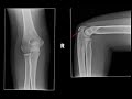 elbow trauma and pain in 11 y.o. girl